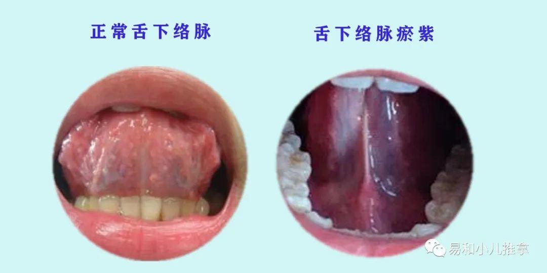 舌下络脉粗胀,呈青紫,绛,绛紫,紫黑色,皆为血瘀.