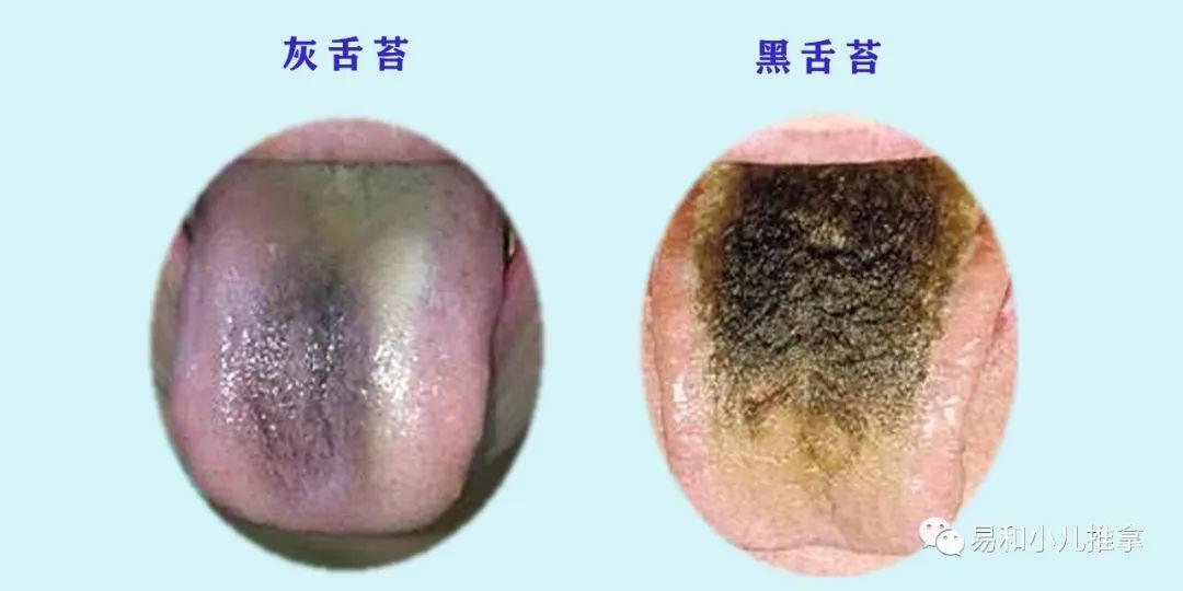 最详细小儿推拿舌诊辩证