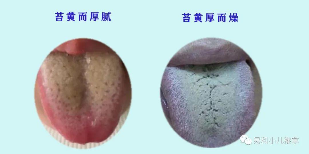 苔黄厚干燥—多为胃热伤津苔黄而厚腻—多为脾胃湿热焦黄燥裂