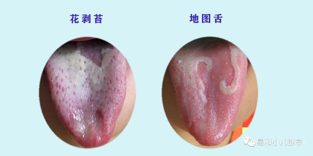 镜面舌(光剥苔) 舌苔全部脱落,光洁如镜 类剥苔 剥落处并不光滑,似有